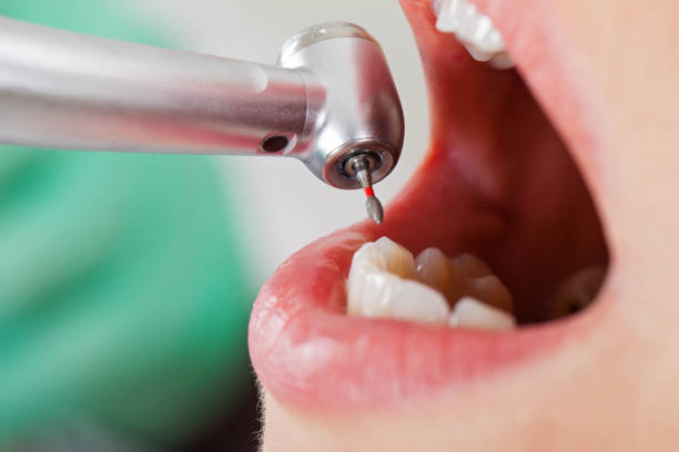 Best Emergency Dentist for Lost Fillings or Crowns in Madison Park, NJ